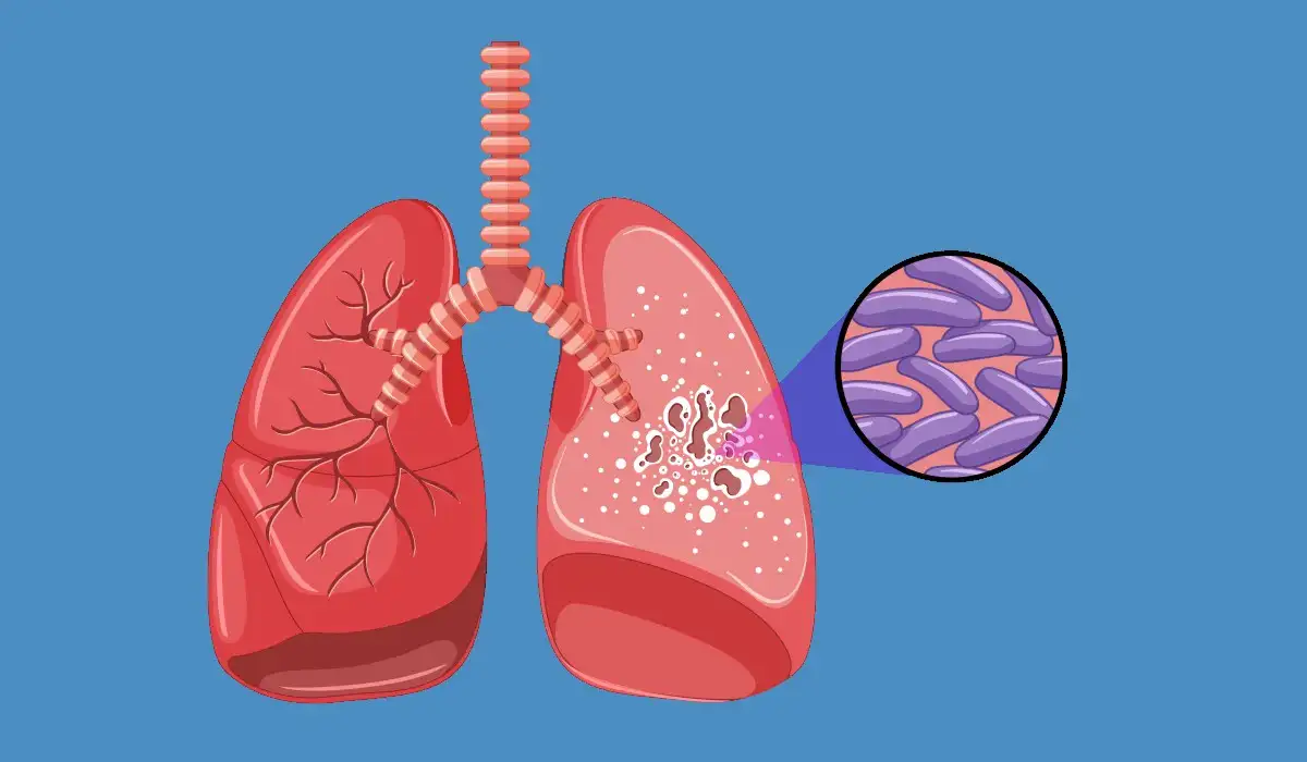 Human lung anatomy with tuberculosis