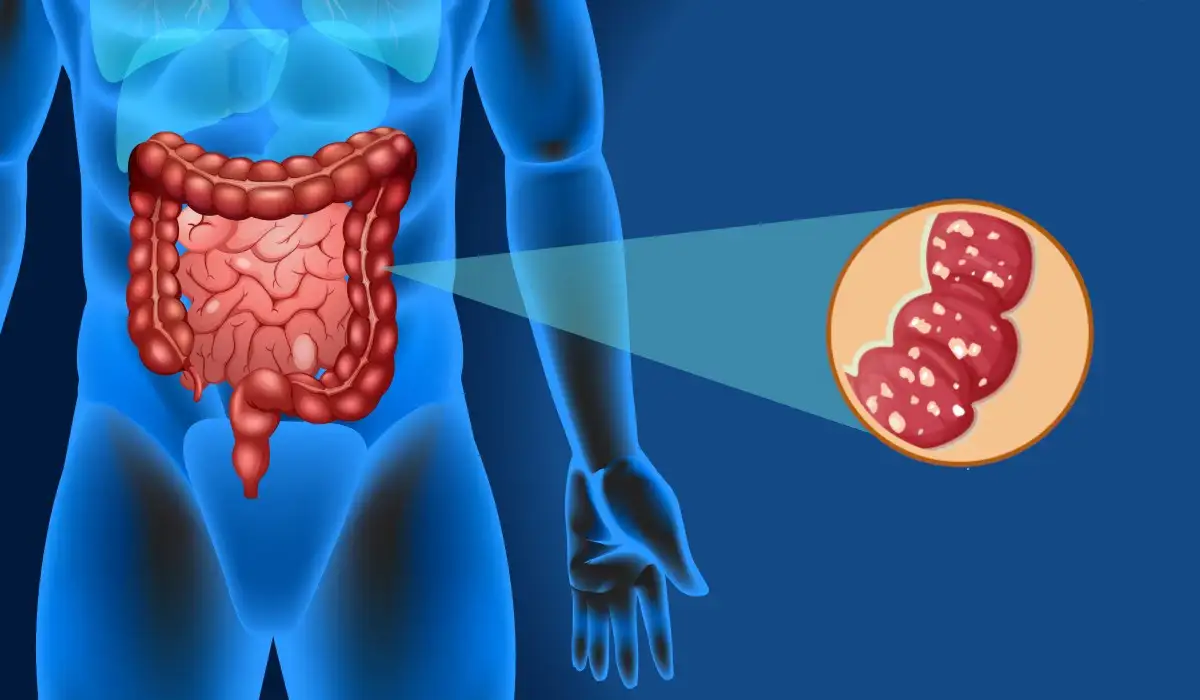 Inflammatory bowel disease ibd infographic