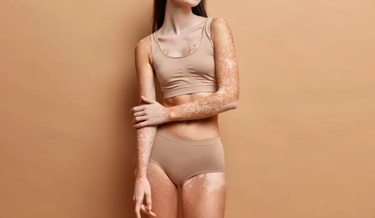 Close up on slim woman with vitiligo skin